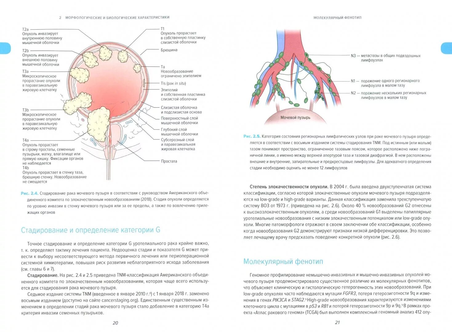 Опухоли мочевого пузыря классификация. Злокачественная опухоль мочевого пузыря. Раковая опухоль мочевого пузыря. Объемное образование мочевого пузыря. Рак мочевого отзывы