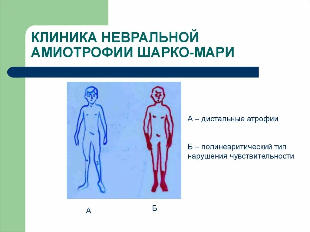 Генетическое заболевание Шарко Мари тута. Невральная амиотрофия. Синдром шарко