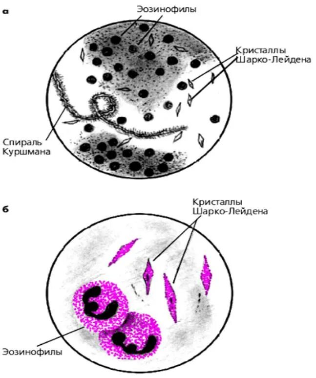 Шарко лейдена в кале. Микроскопия мокроты при бронхиальной астме. Спираль Куршмана в мокроте нативный препарат. Микроскопия мокроты спирали Куршмана. Спирали Куршмана микроскопия.