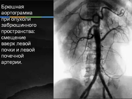 Ангиография аорты