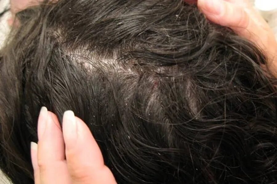 How to Get Rid of Lice