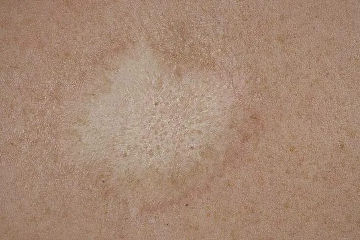 Атрофия латынь. Pityriasis versicolor отрубевидный лишай. Склеро трофический лишай. Отрубевидный (разноцветный лишай) лишай. Белый отрубевидный лишай.