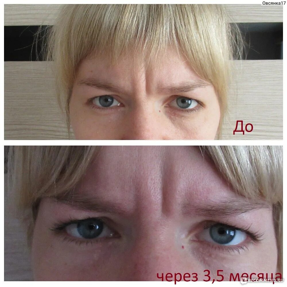 Сколько встает ботокс на лбу. Ботокс в межбровье до и после. уплотнение в межбровье после филлера. уколы филером в межбровку. инъекции межбровка до и после.