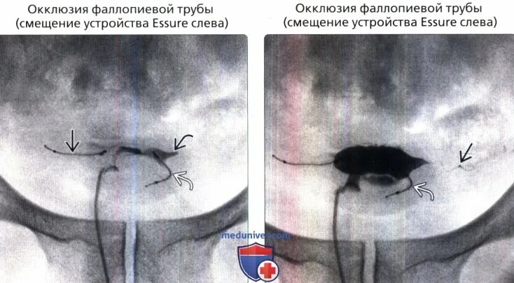Что значит маточные трубы не визуализируются