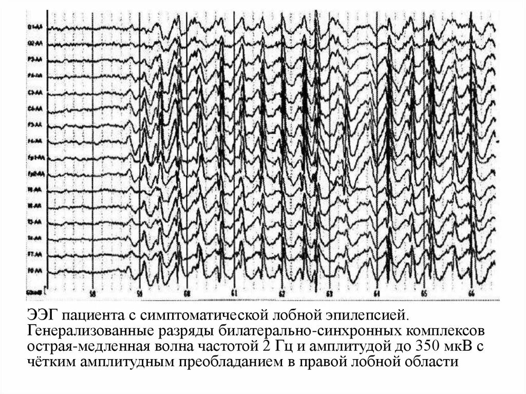 Диффузная эпилептиформная активность. ЭЭГ эпилепсия пик-волна. Комплекс острая медленная волна на ЭЭГ. Комплексы пик волна на ЭЭГ. ЭЭГ при эпилепсии пик волна.