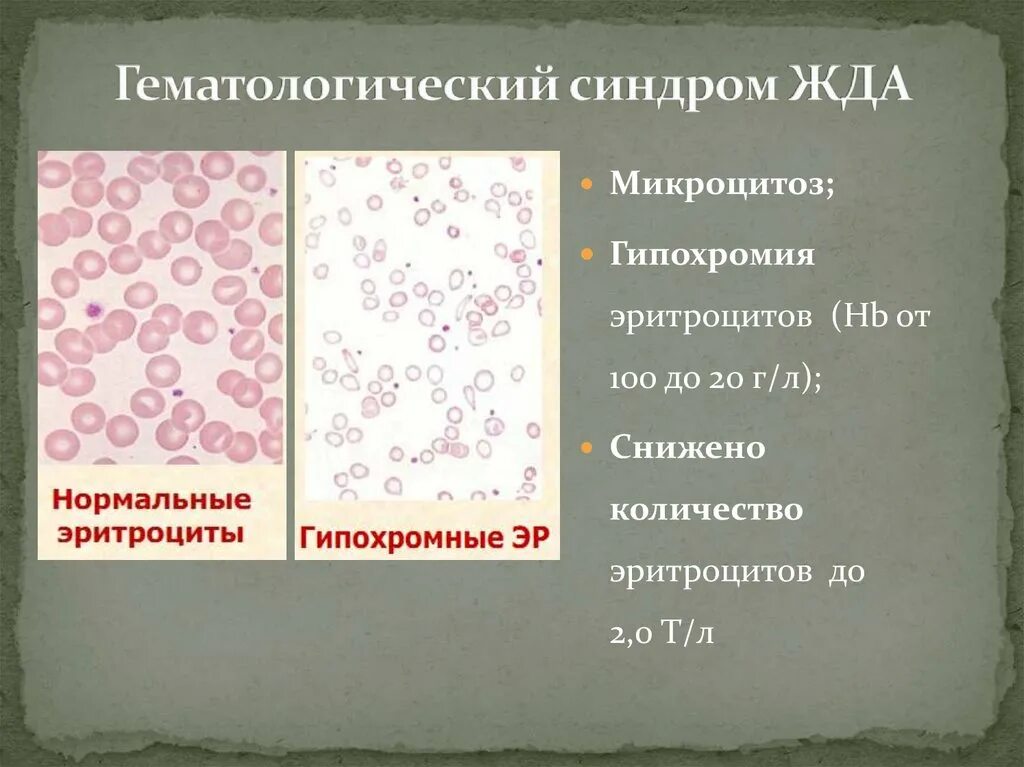 Гипохромия железодефицитная анемия