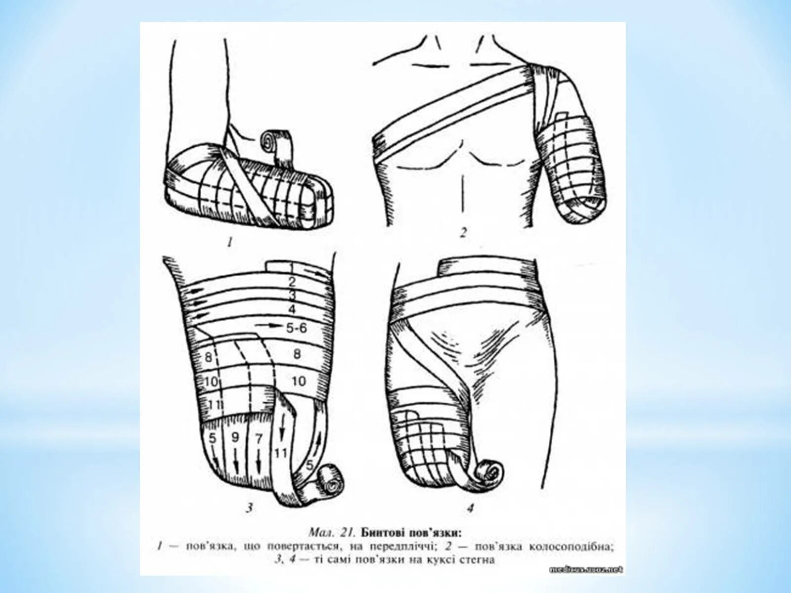Наложение повязки варежка алгоритм. Наложение возвращающейся повязки на культю. Возвращающаяся повязка на культю бедра. Наложение повязки на культю конечности. Повязка на культю алгоритм.