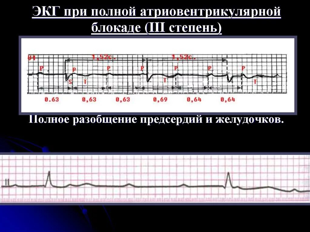 Fuller av. ЭКГ при АВ блокаде 3 степени. ЭКГ признаки полной атриовентрикулярной блокады. Полная АВ блокада на ЭКГ признаки. ЭКГ критерии АВ блокады 3 степени.