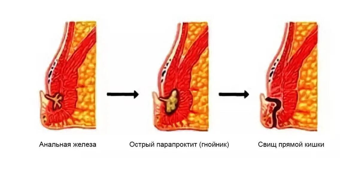 Ощущение в прямой кишке. Клиника подкожного парапроктита. Свищи при хроническом парапроктите. Хронический парапроктит свищи прямой. Острый парапроктит свищ.