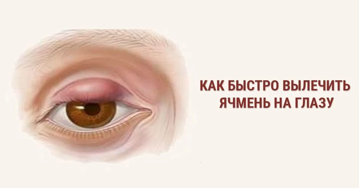 Воспаление века ячмень. Халязион под нижним веком. Заболевания век ячмень. Этапы ячменя. Заболевания век ячмень.