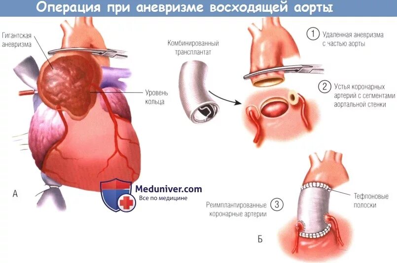 Расширение и дилатация корня аорты. Аневризма восходящей аорты операция