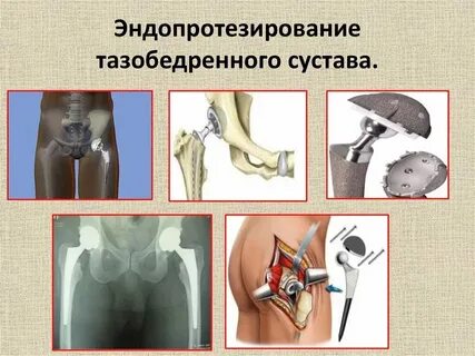 Шов после эндопротезирования тазобедренного сустава