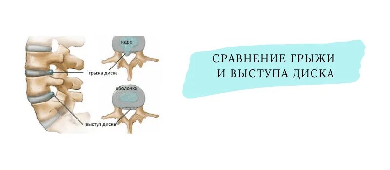 Грыжа диска с6 с7. С6 шейного отдела грыжа. шейная грыжа позвоночника 5- позвонка симптомы. грыжа с5-с6 шейного отдела симптомы. грыжа 7 шейного позвонка симптомы.