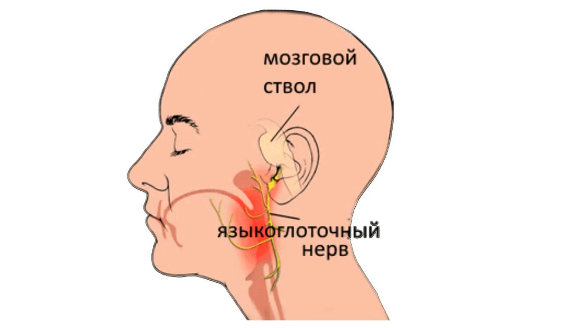 Языково глотательный нерв. Воспаление языкоглоточного нерва. Зона иннервации языкоглоточного нерва. Ушной узел языкоглоточного нерва. Поражение подъязычного нерва