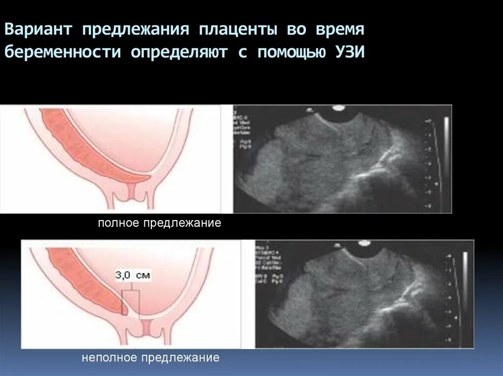 УЗИ при неполном предлежании плаценты. Краевое предлежание плаценты УЗИ. Неполное предлежание плаценты на УЗИ. Полное предлежание плаценты УЗИ. Шейка в 12 недель