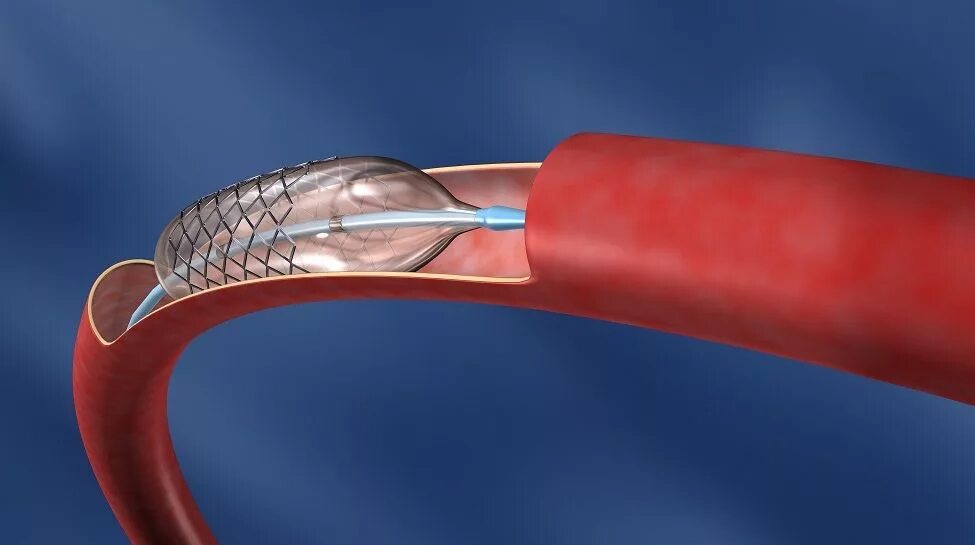 Стент после операции. Баллонная ангиопластика артерий. Эндоваскулярная баллонная ангиопластика. Стентирование сосудов сердца. Эндоваскулярная стентирование сосудов.