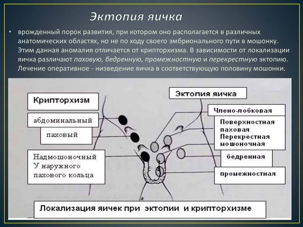 Крипторхизм классификация. Классификация крипторхизма у детей. Эктопия яичка классификация. Не опускаются яички что делать