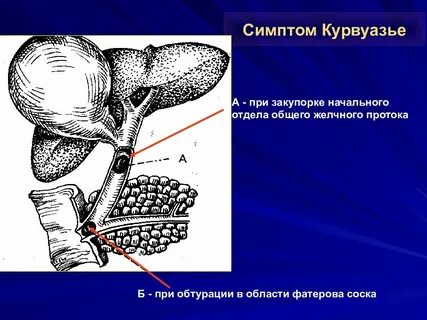 Симптом курвуазье