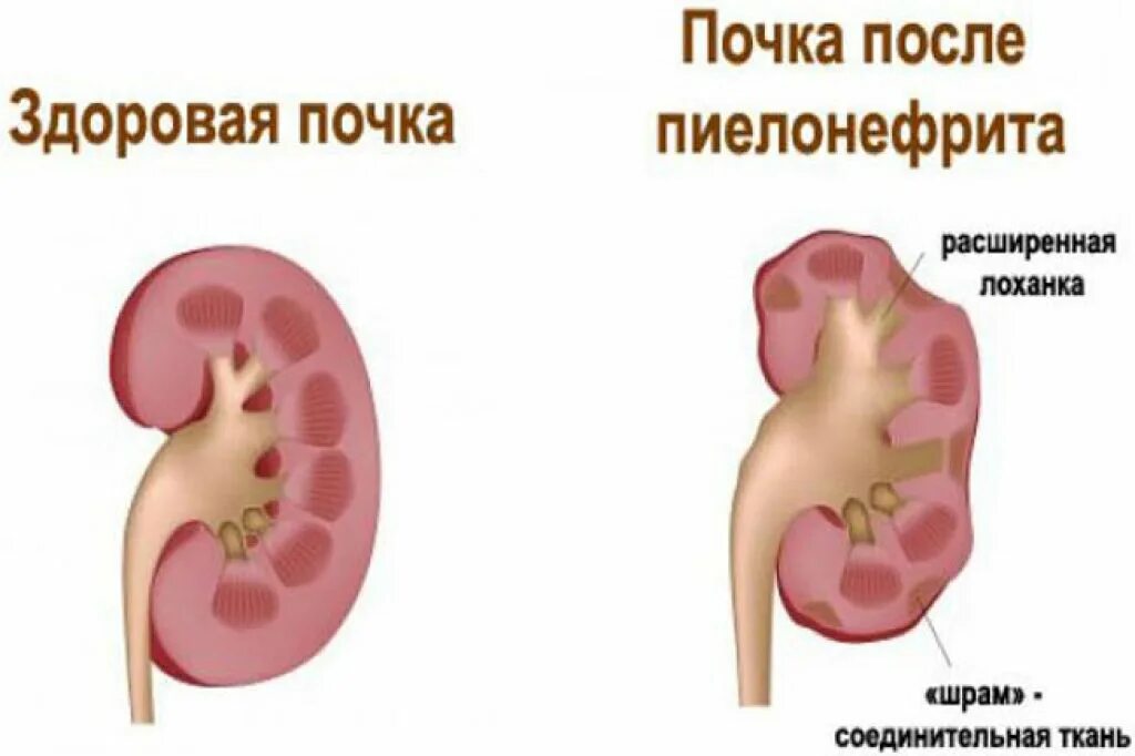Пиелит что это