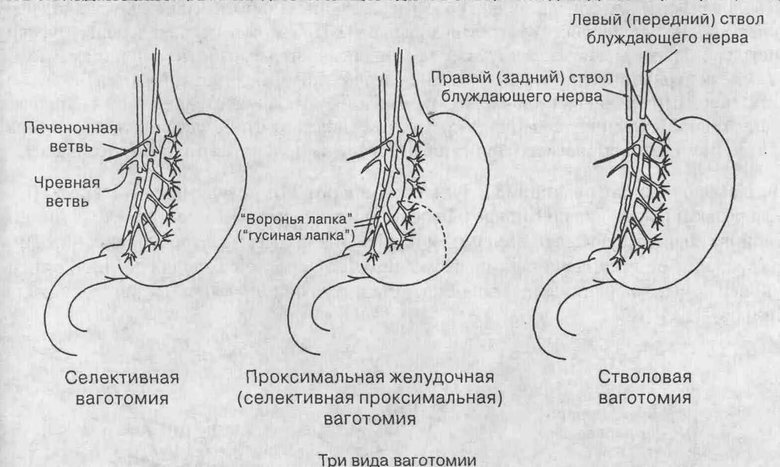 Хирургические заболевания желудка. Стволовая ваготомия в сочетании с дренирующими желудок операциями. Проксимальная резекция желудка схема. Ваготомия при операции на желудке. Селективная ваготомия при язвенной болезни желудка.