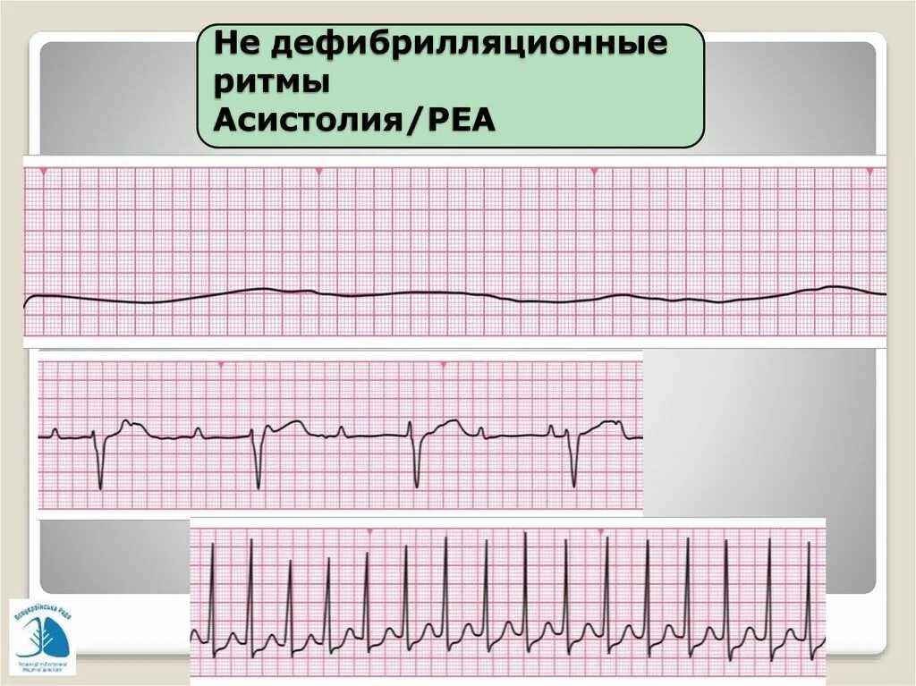 Асистолия на ЭКГ. Асистолия желудочков на ЭКГ. Асистолия сердца на ЭКГ. Изменения на ЭКГ при асистолии.