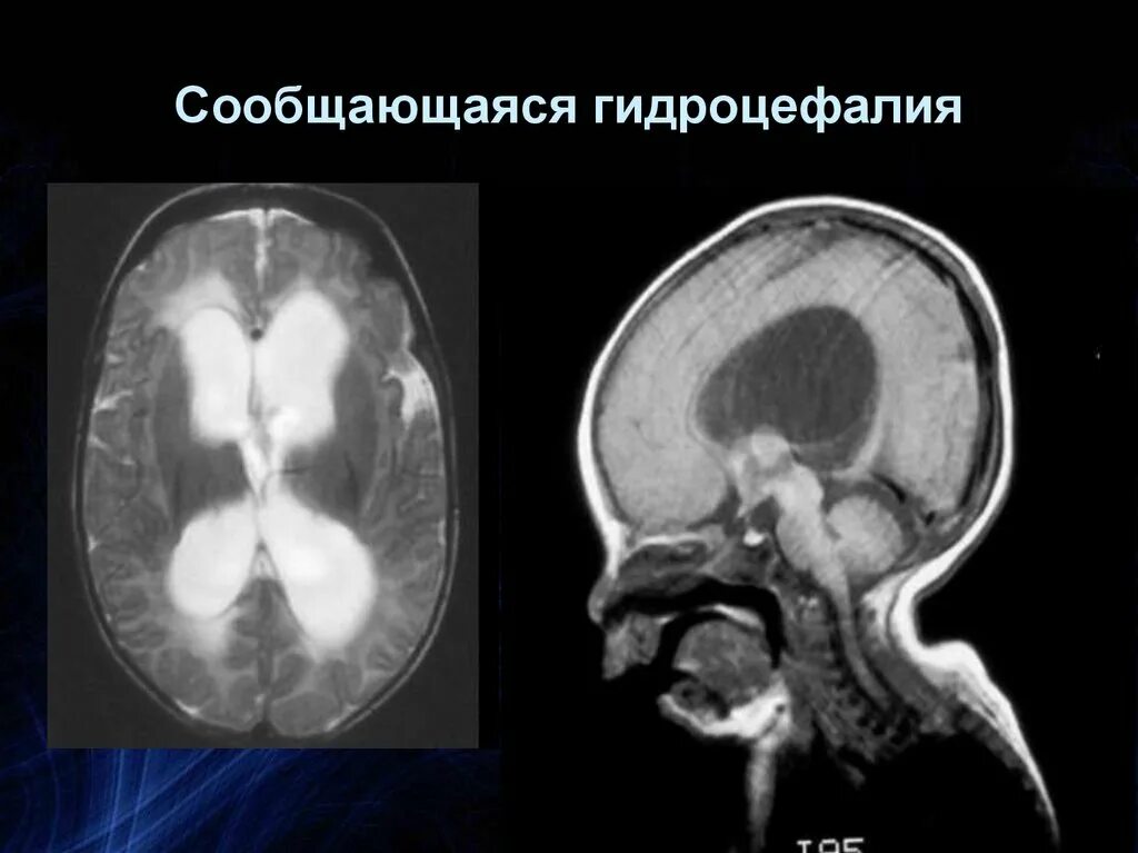 Выраженная заместительная гидроцефалия. Декомпенсированная гидроцефалия. Компенсированная гидроцефалия кт. Сообщающаяся гидроцефалия.