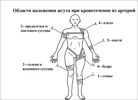 Где нельзя накладывать жгут