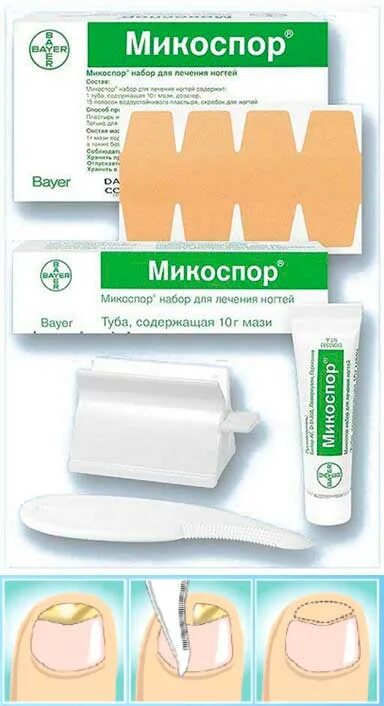 Кератолитический пластырь для ногтей. Микоспор набор мазь. Микоспор набор для ногтей. Выпрямитель для ногтей на ногах. Gehwol гель-кольцо g 30мм 2шт.
