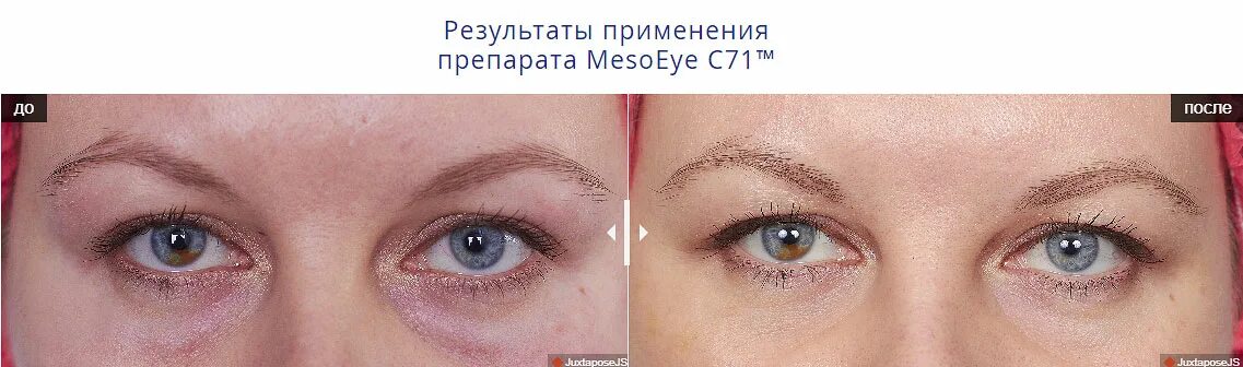 Мезая. МЕЗОАЙ С 71. МЕЗОАЙ С 71 под глаза. Биоревитализация MESOEYE. Мезо айс 71 для глаз.