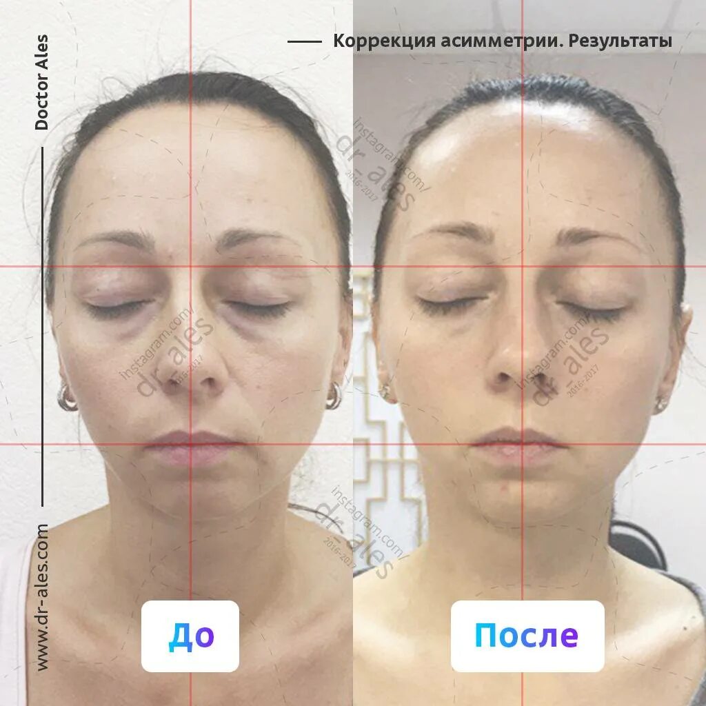 асимметрия лица. коррекция асимметрии лица. исправление асимметрии лица. симметричные на щеках. симметричные на щеках.