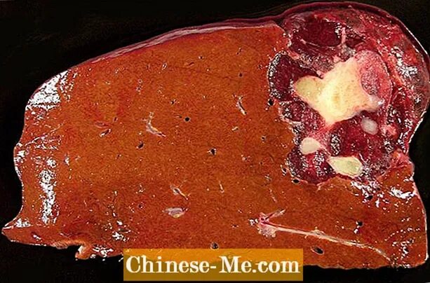 Кавернозная гемангиома печени. Печень исчезает. Токсическое поражение печени. Куриная печень испортилась. Заболевания печени (острые и хронические гепатиты, циррозы печени):.