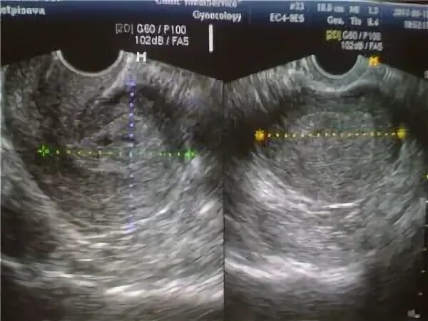 Матка увеличена до 6 недель. Гиперэхогенный неоднородный эндометрий. Гиперэхогенный полип эндометрия. Неоднородный эндометрий 12 мм. Эндометрий на УЗИ при беременности.