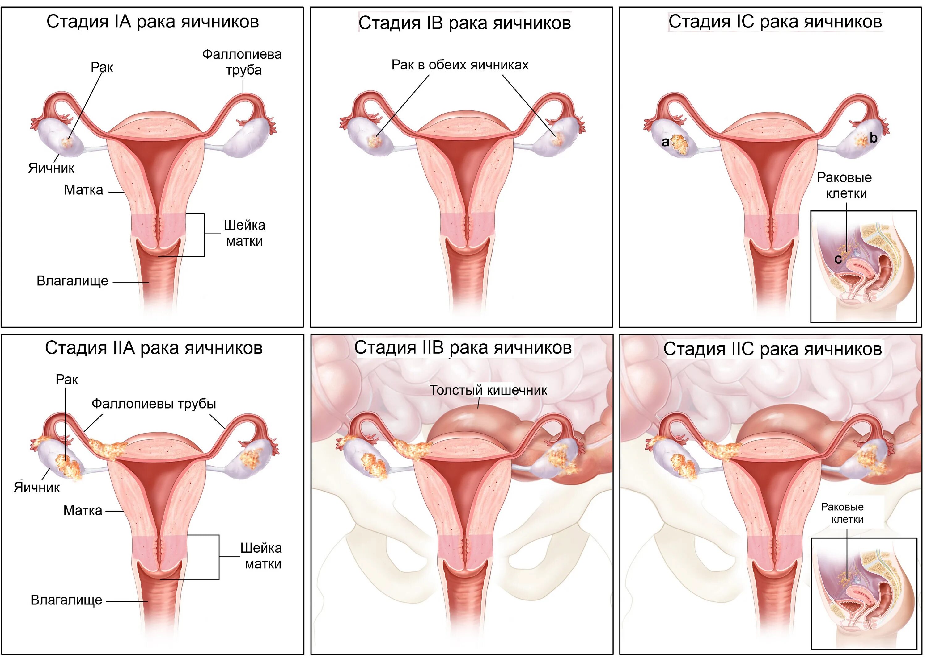 Стадии опухоли яичников. Злокачественные новообразования яичников. Опухоли матки и яичников. Раковая опухоль яичника. Степени рака яичников