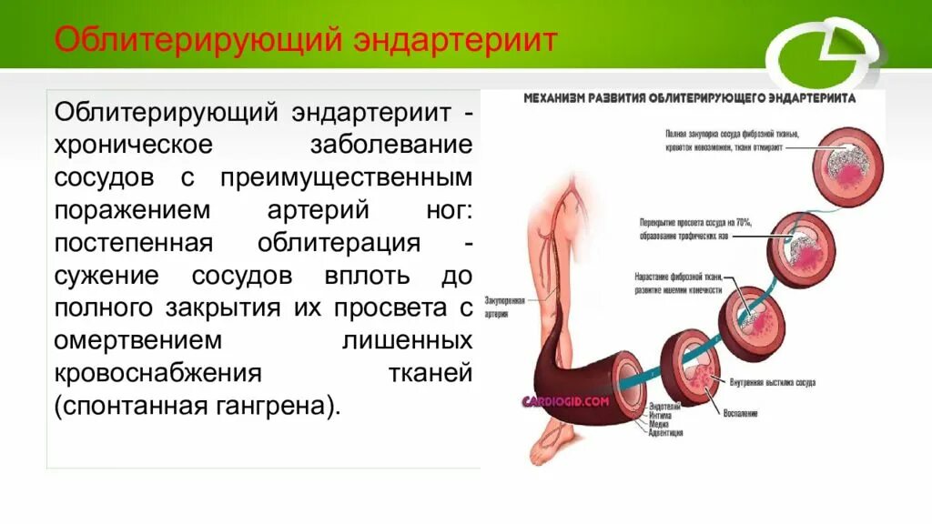 Эндартериит и ангионевроз являются профессиональными заболеваниями связанными. Облитерирующий эндартериит. хронические заболевания ссс. заболевание облитерирующий эндартериит. облитерирующий эндартериит презентация.