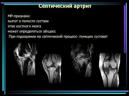 Выпот коленного сустава что это