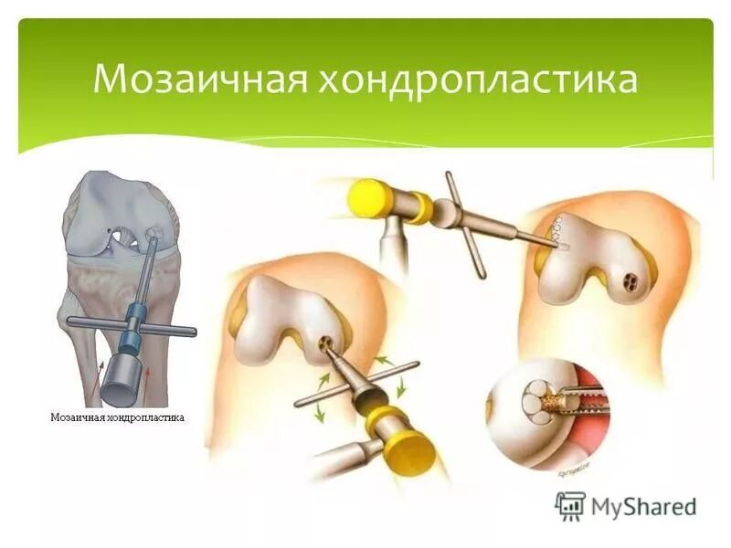 Абразивная хондропластика коленного сустава. Абразивная хондропластика коленного сустава. Болезнь кенига коленного сустава. Шейверная хондропластика коленного сустава. Абразивная хондропластика коленного сустава.