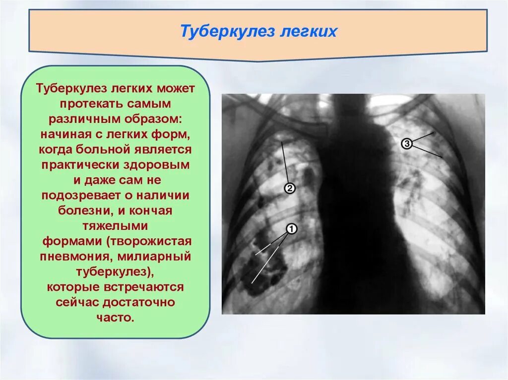 Презентация на тему туберкулез легких.