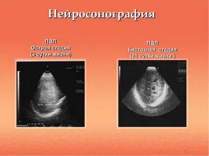 Ишемия 2 степени