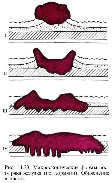 Диффузно инфильтративная. Классификация Ракка желудка ОП форме. Различные формы опухолей. Формы роста опухоли желудка.