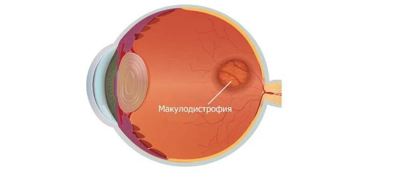 Возрастная макулодистрофия лечение. Макула дистрофия сетчатки. возрастная макулярная дегенерация. макулярная дегенерация сетчатки глаза. центральная дистрофия сетчатки глаза.