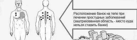 При каком кашле ставят банки. Схема установки вакуумных банок на спину при кашле. места постановки банок схема. схема постановки медицинских банок. куда можно ставить банки.