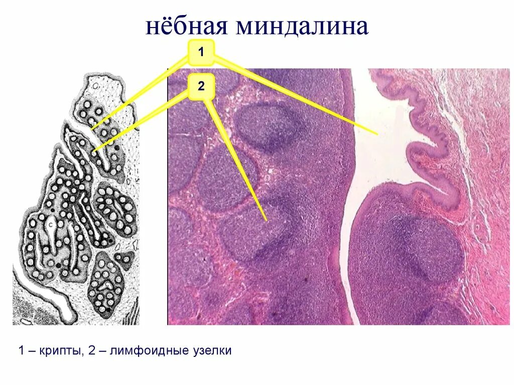 Небная миндалина гистология. Глоточная миндалина гистология. Строение небной миндалины гистология. Небная миндалина гистология препарат. Кт миндалин