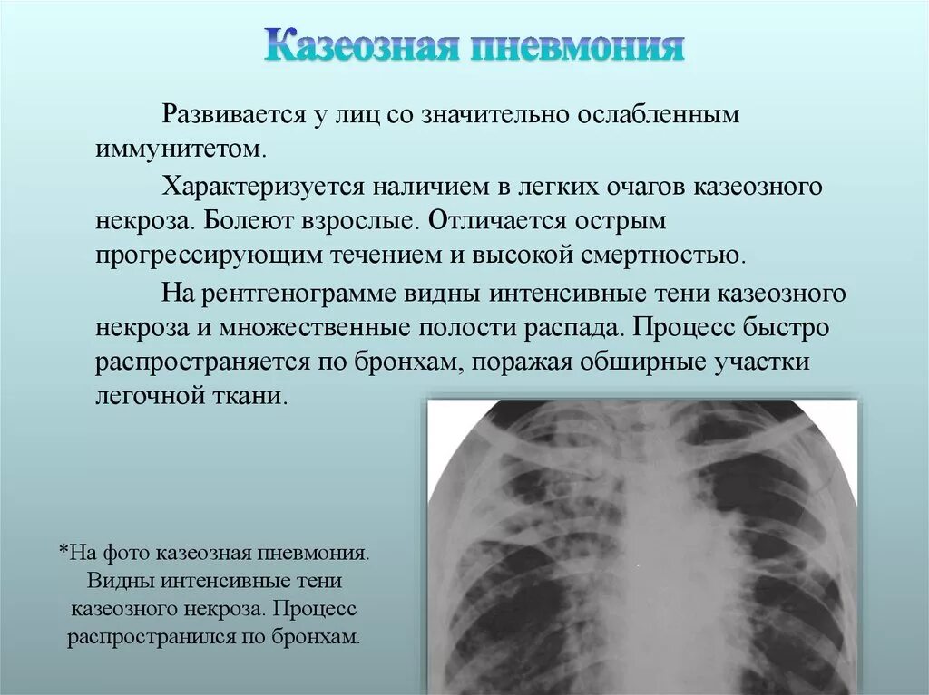 Казеозная пневмония туберкулез. Казеозная пневмония рентген. Казеозная пневмония аускультация. Лобарная казеозная пневмония рентген. Легкое течение пневмонии