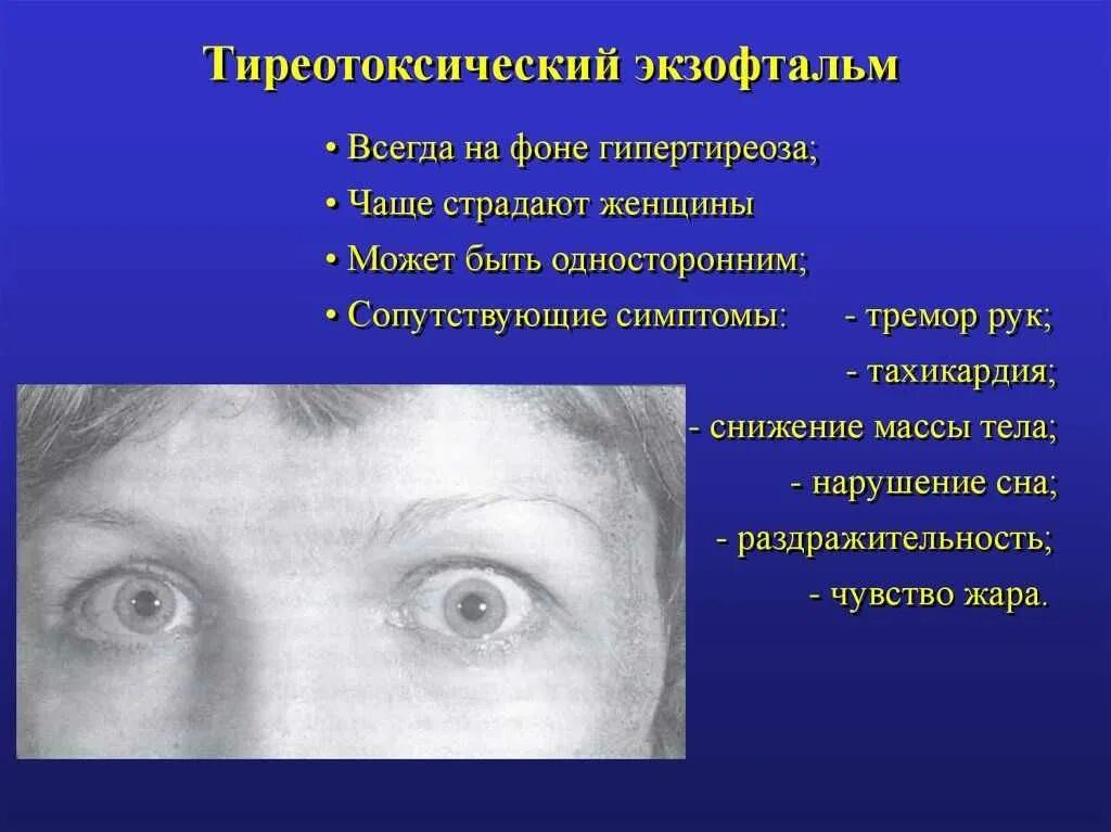 Экзофтальм наблюдается при. Тиреотоксикоз офтальмопатия эндокринная. Базедова болезнь экзофтальм. Тиреотоксический экзофтальм симптомы. Экзофтальм при тиреотоксикозе.