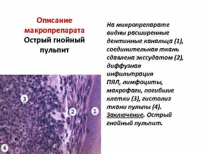 Серозный пульпит гистология. Гнойный менингит препарат патанатомия. Инфильтрация патанатомия. Гнойный пульпит микропрепарат.