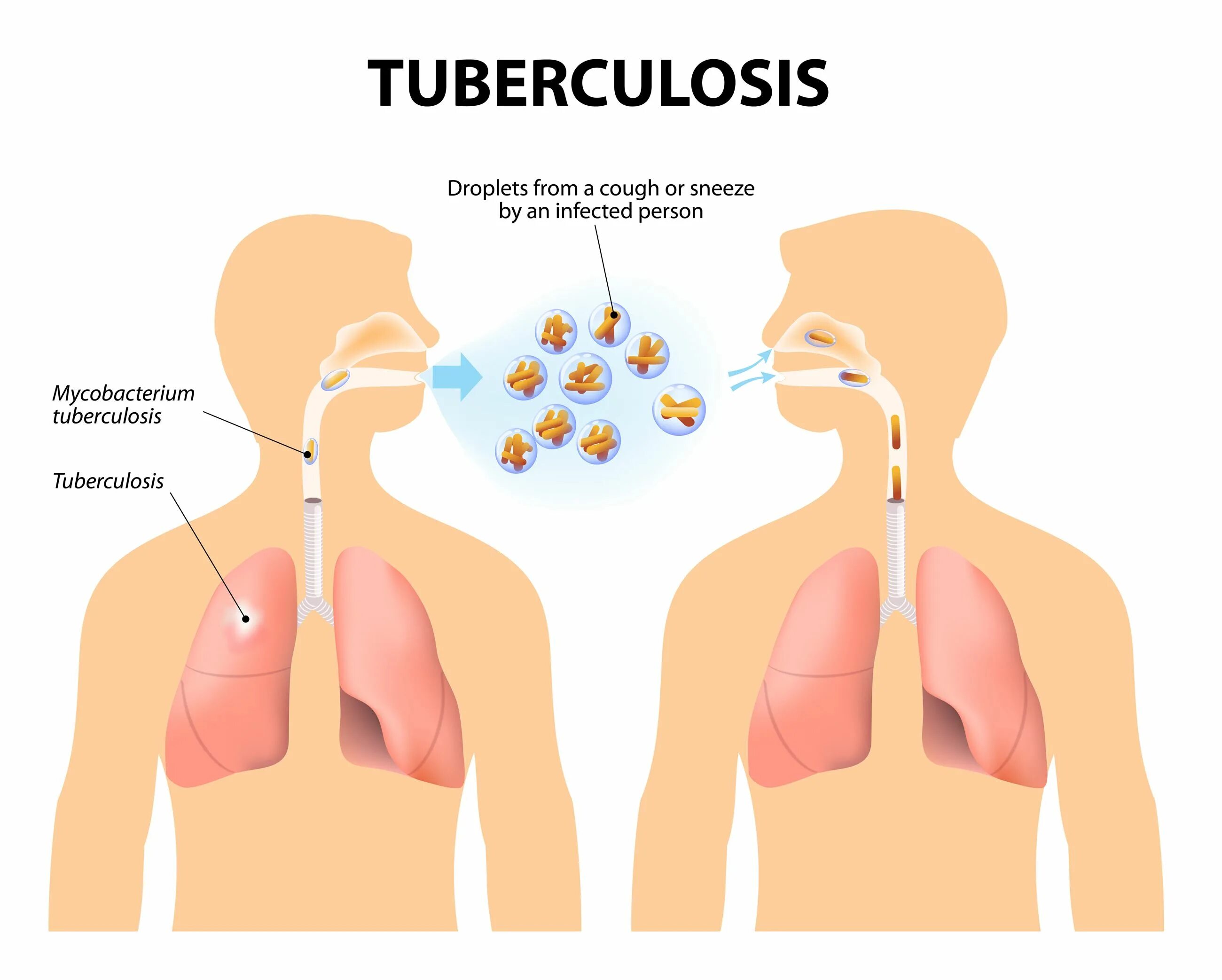 Путь заражения медперсонала туберкулезом