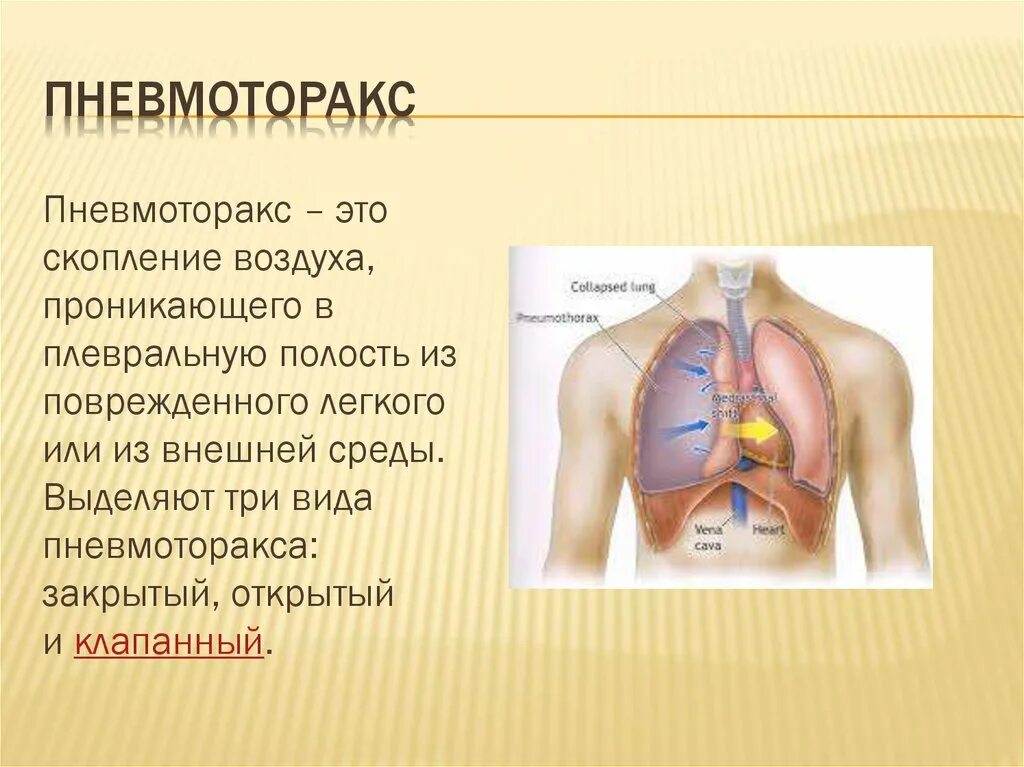 Помощь при открытом пневмотораксе тест. Помощь при открытом пневмотораксе тест