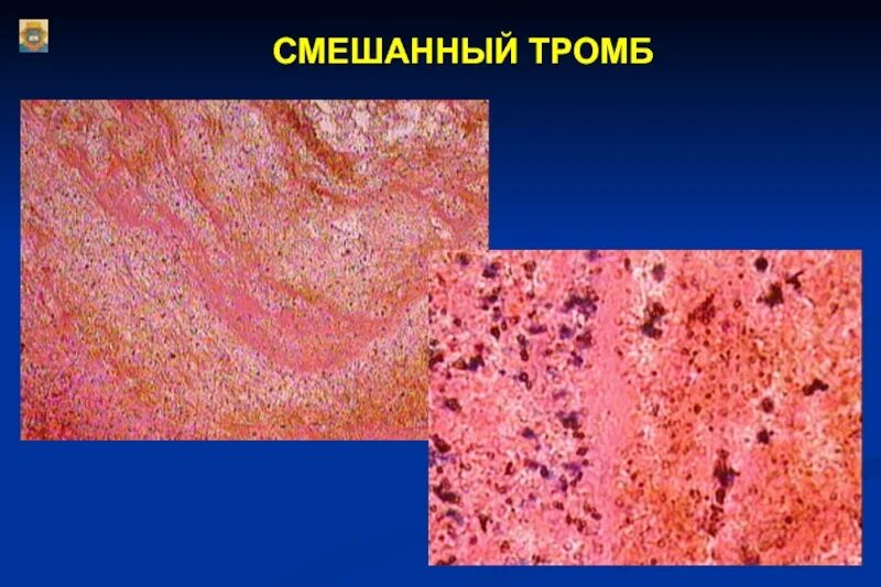 Смешанный тромб микропрепарат патанатомия. Красный тромб микропрепарат. Смешанный тромб в Вене микропрепарат. Красный тромб в Вене микропрепарат. Строение тромба
