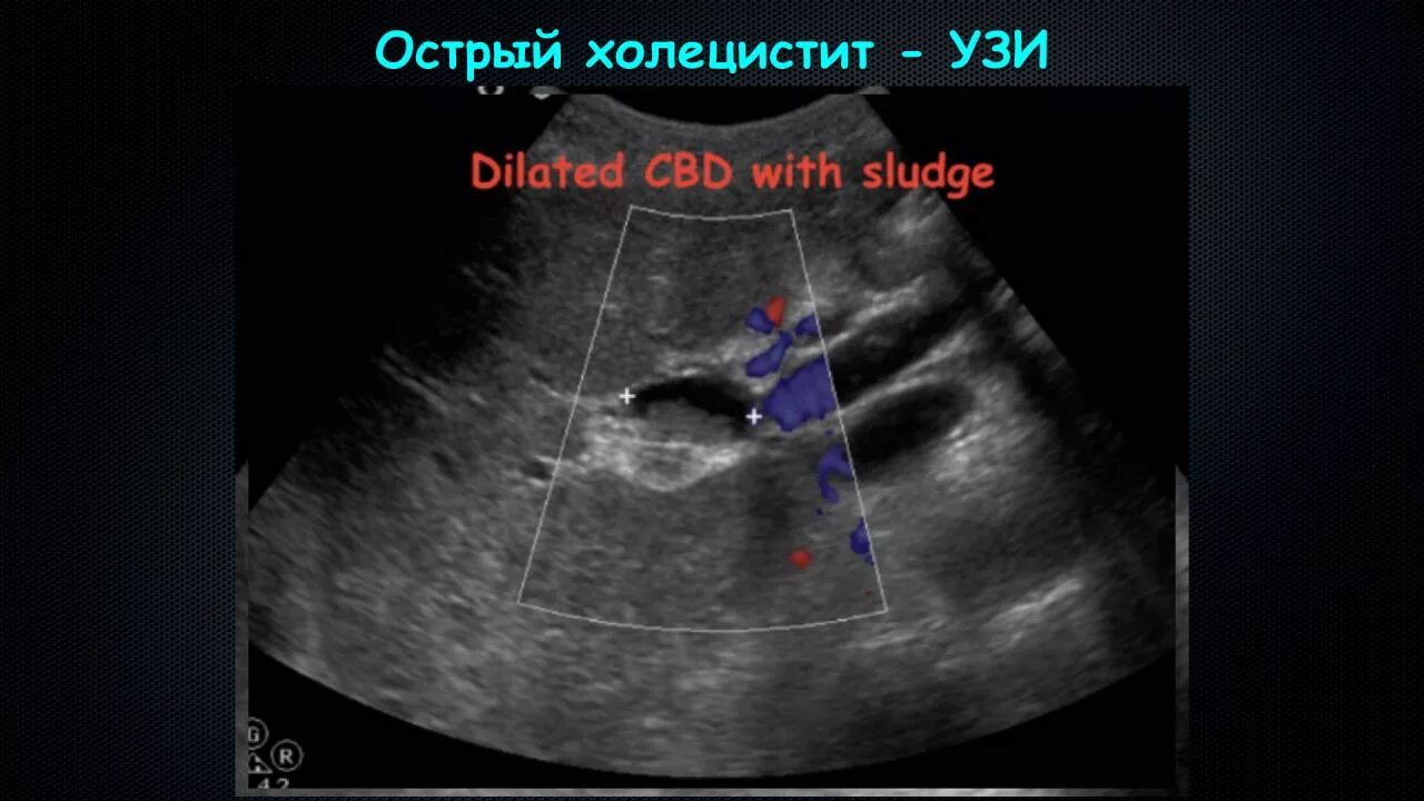 Острый калькулезный холецистит симптомы. Воспалённый желчный пузырь. Жкб камни желчного пузыря. Желудок острый холецистит. Острый калькулезный холецистит кт.