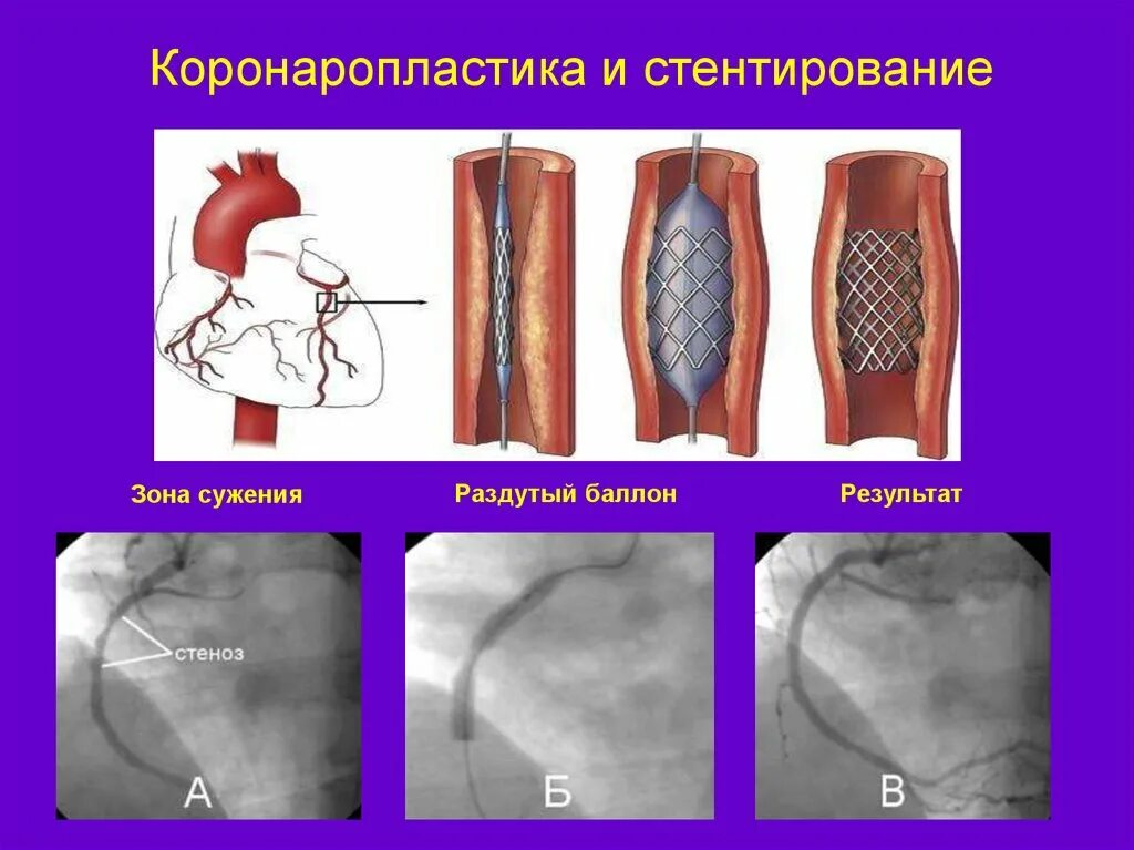 Коронарное стентирование сосудов сердца. Инфаркт миокарда операция стентирование. Стентирование коронарных артерий схема. Стентирование сосудов при инфаркте. Стентирование сосудов последствия